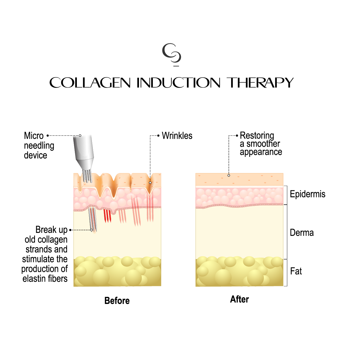 Collagen induction therapy (microneedling)