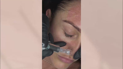 Cover image of a video demonstrating Collagen Induction Therapy (CIT) in action, featuring a skilled practitioner applying the treatment to a client's skin, with close-ups of the microneedling tools and techniques used to stimulate collagen production and enhance skin elasticity.